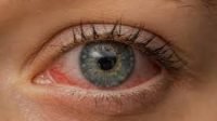 Gejala Kolesterol Tinggi yang Muncul di Mata, Waspadai Tanda-Tandanya!