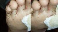 Kaki Dikerumuni Semut Disebut Tanda Diabetes Menurut Dokter